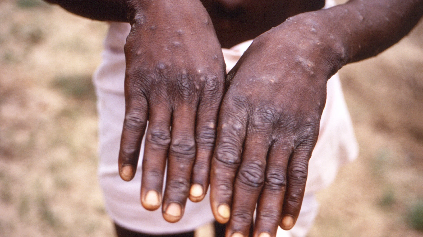 Gefährliche Mpox-Variante breitet sich aus, © Keystone / AP CDC Gefährliche Mpox-Variante breitet sich aus, © Keystone / AP CDC