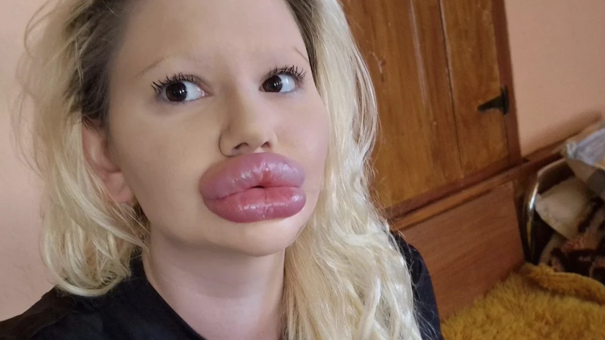 Tam 32 estetik operasyon geçirdi! Hayati tehlikesi var..., © Fotograf fenomenin kendi resmi hesabından alınmıştır. Tam 32 estetik operasyon geçirdi! Hayati tehlikesi var..., © Fotograf fenomenin kendi resmi hesabından alınmıştır.