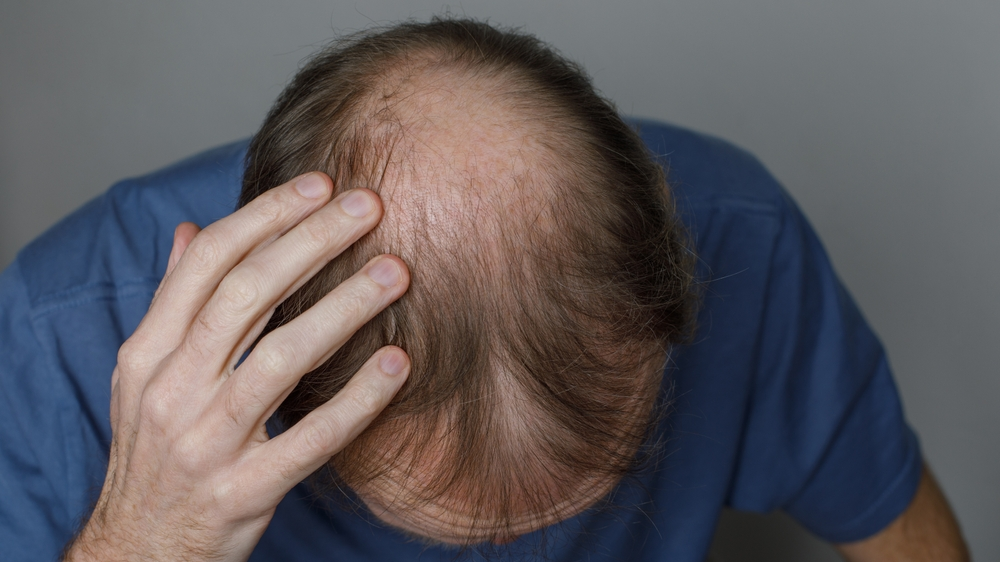 Saç Dökülmesine Karşı 2024'ün En İyi 12 Yöntemi, © shutterstock