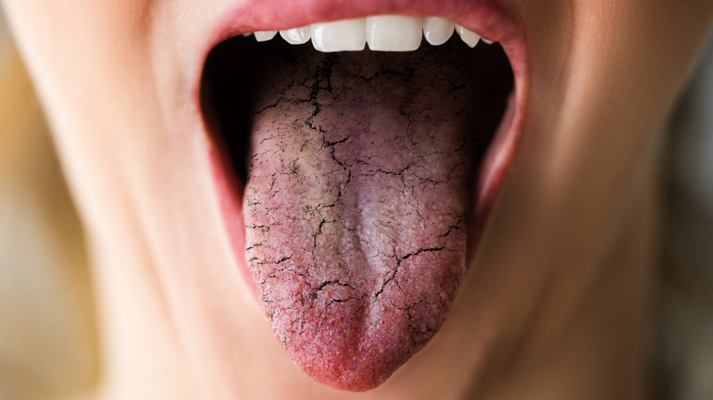 Ağzınız sinyal veriyor: Dilinizdeki bu renklere dikkat! Kanser veya diyabet belirtisi olabilir, © shutterstock