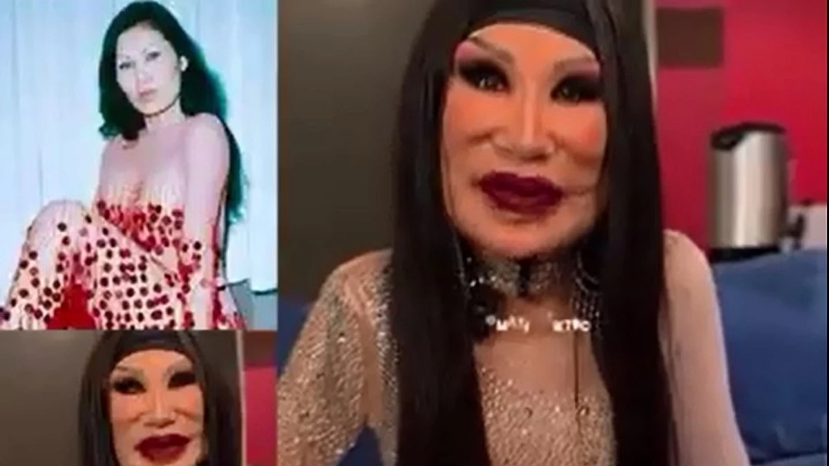 Yüzüne Botox Yerine Yemeklik Yağ Enjekte Edildi, © onedio Yüzüne Botox Yerine Yemeklik Yağ Enjekte Edildi, © onedio