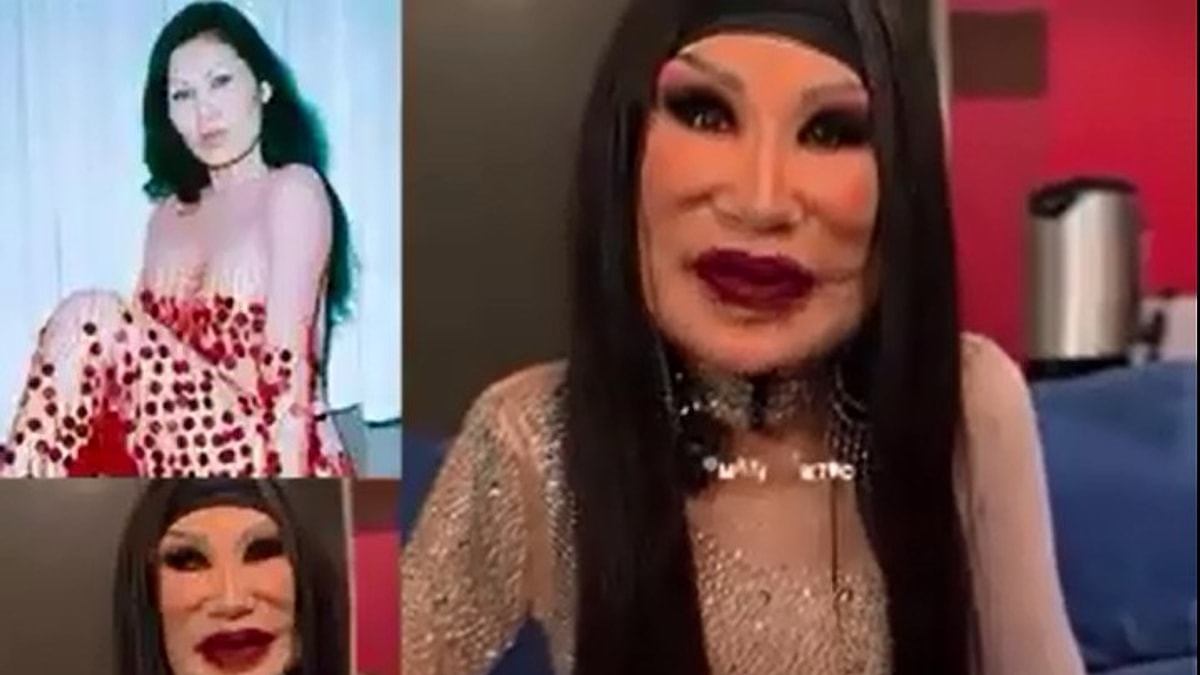 Yüzüne Botox Yerine Yemeklik Yağ Enjekte Edildi, © onedio