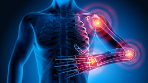 Supersubstanz gegen Rheuma?, © zVg