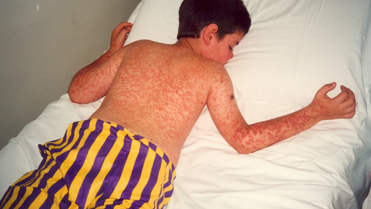 Masern, © Keystone-SDA Masern, © Keystone-SDA