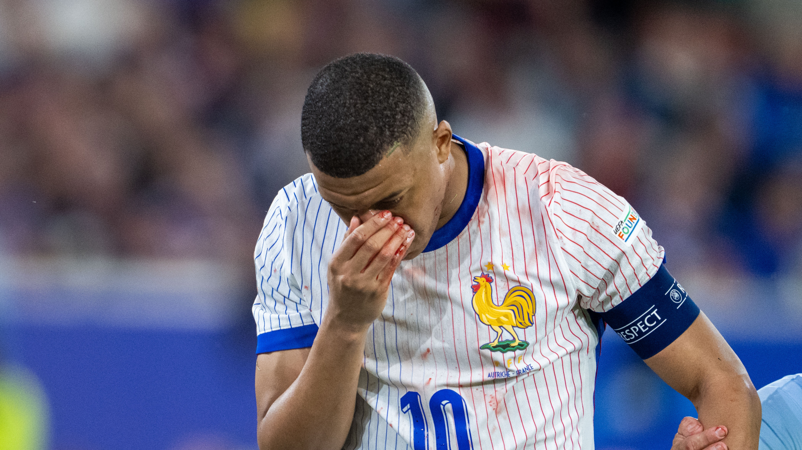 Nasenbeinbruch bei Mbappé bestätigt, © Keystone-SDA